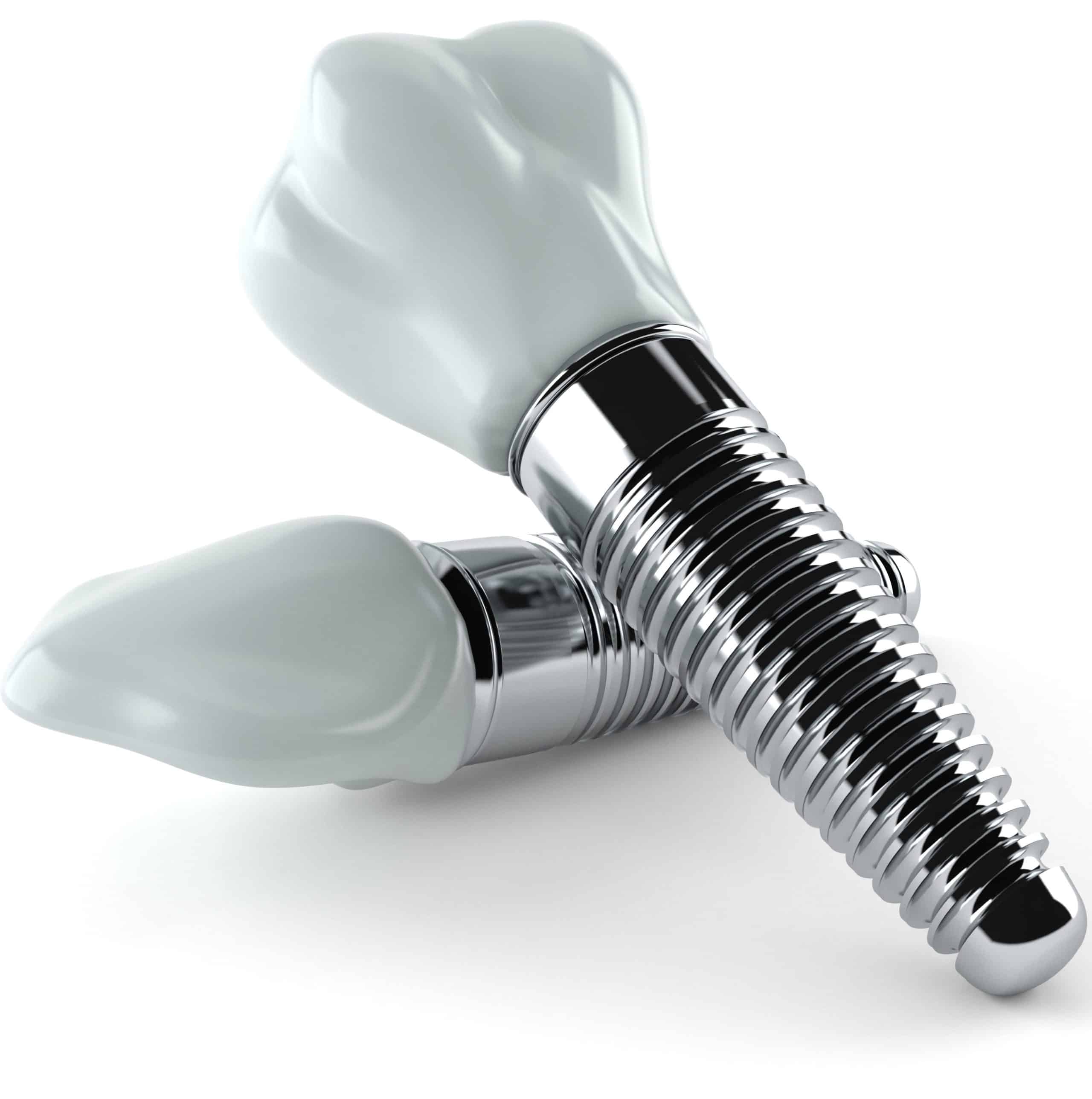 Dental implants waiting to be fitted to a North Vancouver patient