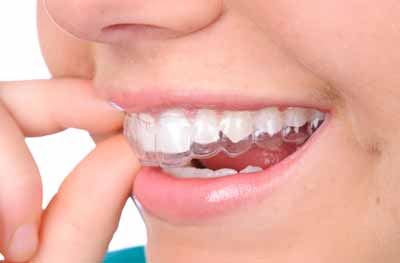 Invisalign in North Vancouver is helping this patient get straighter teeth