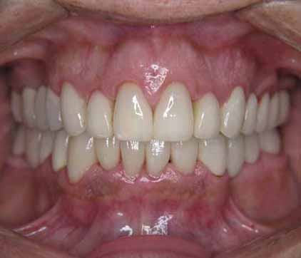 restorative dental after