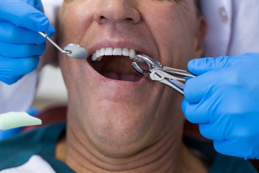 tooth extractions FAQ