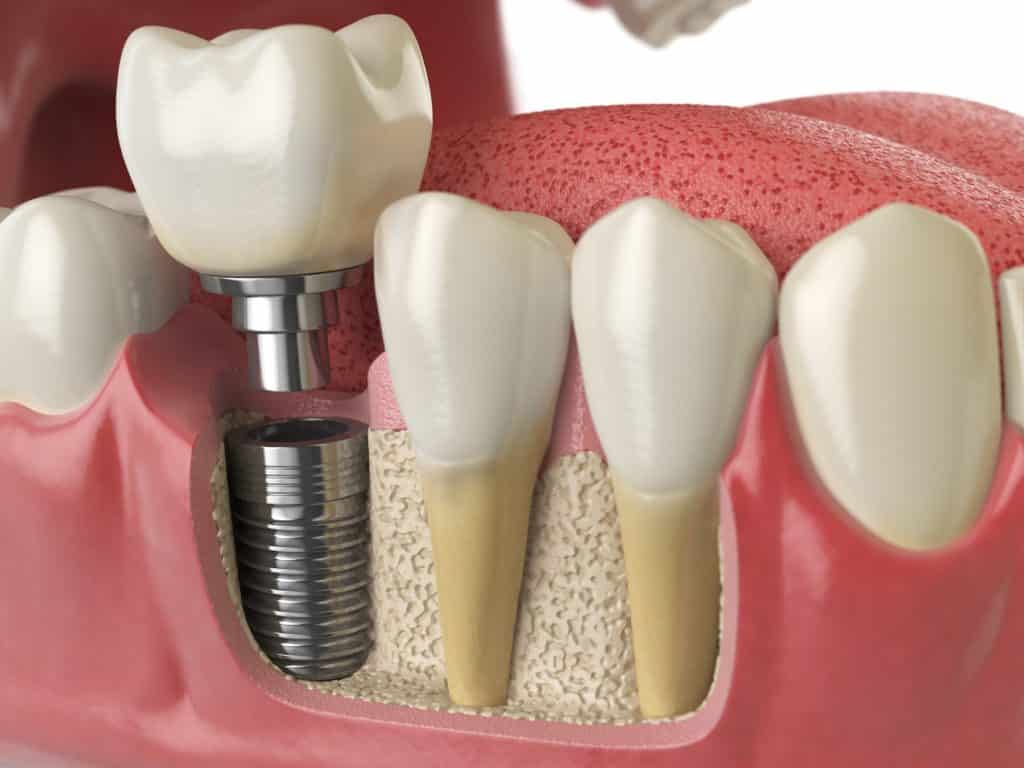 tooth implant costs in North Vancouver